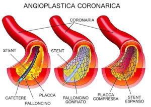 tag-angioplastica-coronarica-ok